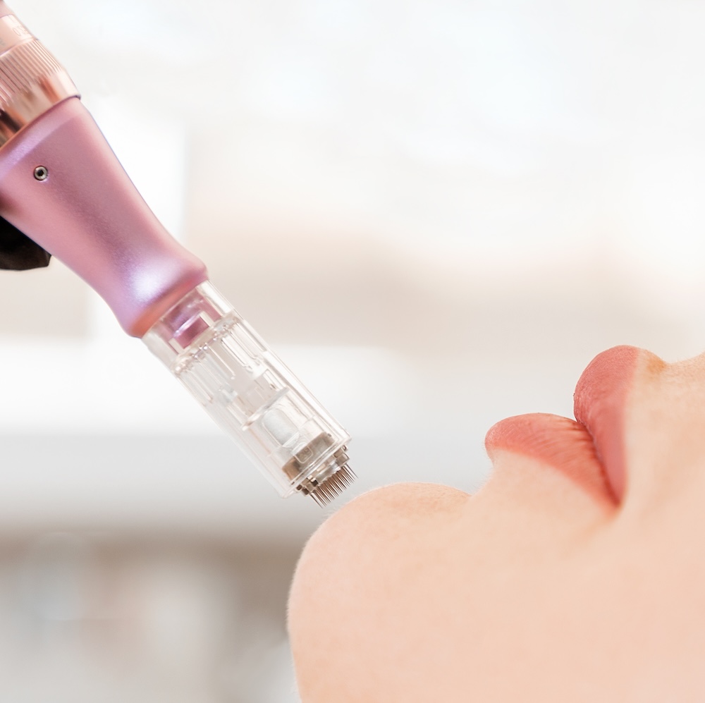 Microneedling with Microinfusion Services